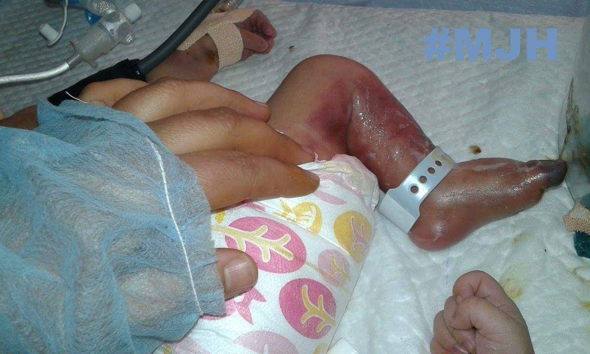 Kreeri family alleges their new-born died of ‘blower heat’ at GB Pant hospital