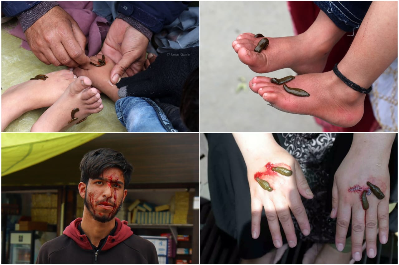 Kashmir On ‘Navroz’ hundreds let leeches suck their blood in hope of getting rid of long-time aliments